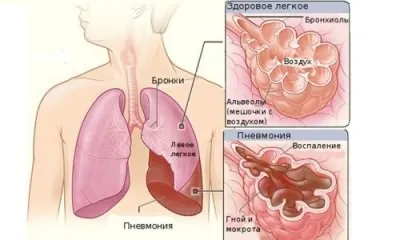 Hogyan juthat el a tüdőgyulladás
