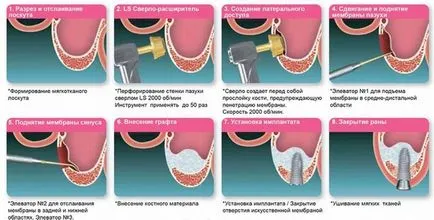 Cum este gingii capacitate indicațiile, tipurile de tranzacții, prețul