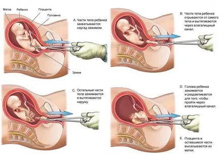 Hogyan, hogy a fajta abortusz abortusz