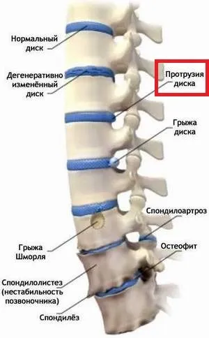 Протрузія міжхребцевих дисків