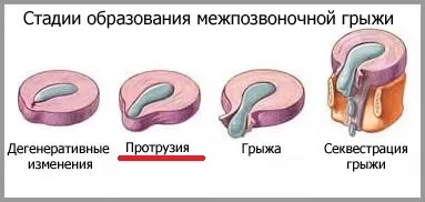 Протрузія міжхребцевих дисків