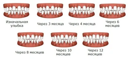 Прозорі брекети показання до застосування, тривалість і вартість лікування, фото до і після