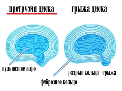 Протрузія міжхребцевих дисків