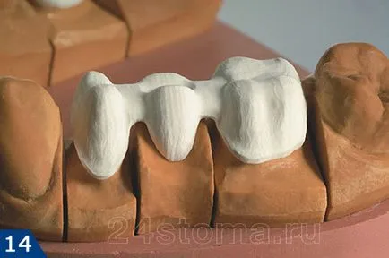Hogyan tegyük egy korona a fog, fogászat