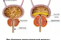 Cum de a reduce dimensiunea prostatei