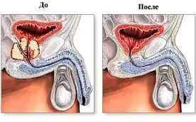 Cum de a reduce dimensiunea prostatei