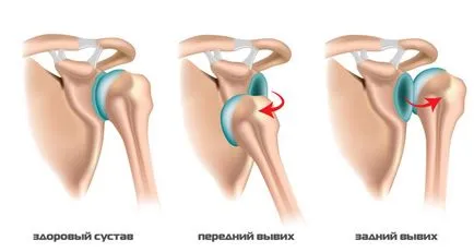 Atât la dislocarea umărului drept la