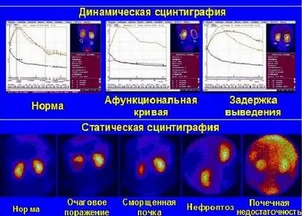 smaragd rinichi, și că acest lucru este tratamentul și simptomele