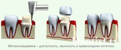 Ceramică, preț și fotografii dinți metal-ceramică