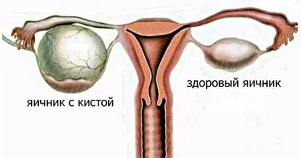 chist ovarian, EUROLAB, ginecologie