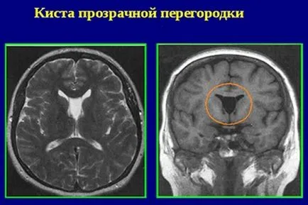 Chist partiție transparent creier, glanda pituitară, cerebel