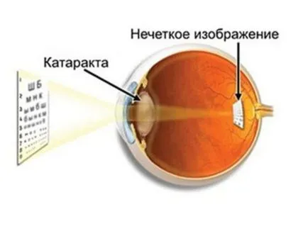 Операция на катаракта, рехабилитация, възстановяване, съвети