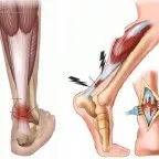 O fractură de compresie a coloanei vertebrale sau compresie spinală