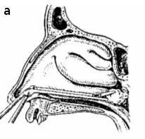 Turbinotomy orrkagylócsontok