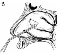 Turbinotomy спирална