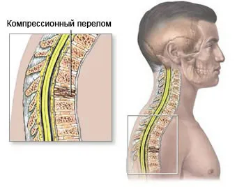 А компресия фрактури на гръбнака или гръбначния компресия