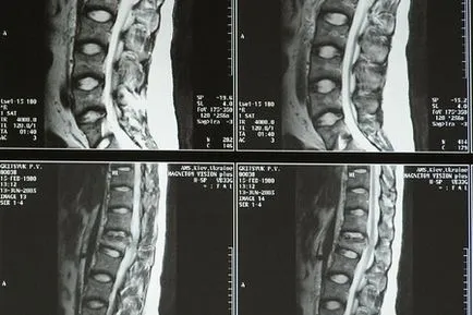 Tomografia computerizată a coloanei vertebrale a vertebrelor cervicale, toracice și lumbosacral