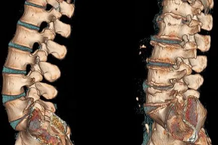 Tomografia computerizată a coloanei vertebrale a vertebrelor cervicale, toracice și lumbosacral
