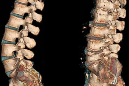 CT-a gerinc, a nyaki, mellkasi és ágyéki-keresztcsonti