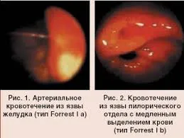 Кървене язва на стомаха, как да се спре