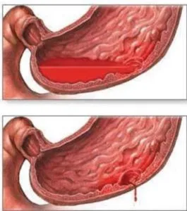 Sângerare ulcer gastric cum să se oprească