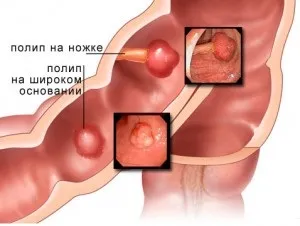 Рак прямої кишки симптоми, лікування, стадії захворювання (лікування) Рак прямої кишки симптоми, лікування, стадії захворювання
