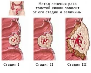 Рак прямої кишки симптоми, лікування, стадії захворювання (лікування) Рак прямої кишки симптоми, лікування, стадії захворювання