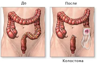 Рак прямої кишки симптоми, лікування, стадії захворювання (рак пряма кишка симптом причина лікування) Рак прямої кишки симптоми, лікування, стадії захворювання