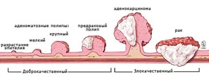 Рак прямої кишки симптоми, лікування, стадії захворювання (прямий) Рак прямої кишки симптоми, лікування, стадії захворювання