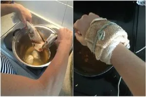 Лікування артриту народними засобами (лікування) Лікування артриту народними засобами