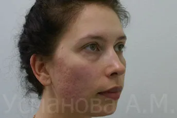 Tratamentul de acnee, tratamentul inflamațiilor feței, tratamentul cu laser de acnee, acnee tratament Elos