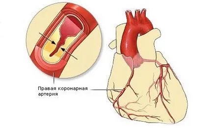 Tratamentul de droguri boli coronariene si medicamente, simptome