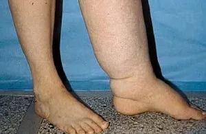 Lymphedema лечение на лимфедем народни средства и методи