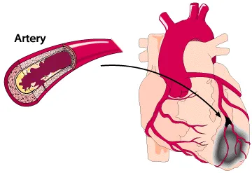 Miocardiodistrofia - Tratamentul de remedii populare