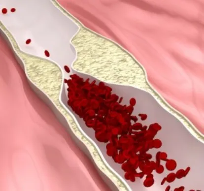 Myocardiodystrophy - kezelése népi jogorvoslat