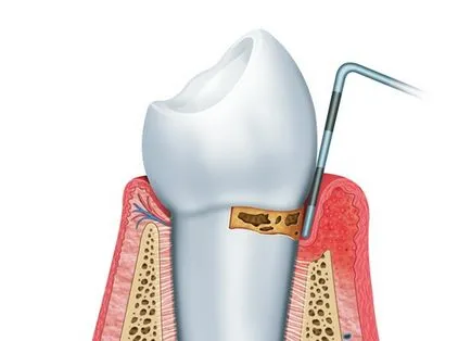 Miocardiodistrofia - Tratamentul de remedii populare