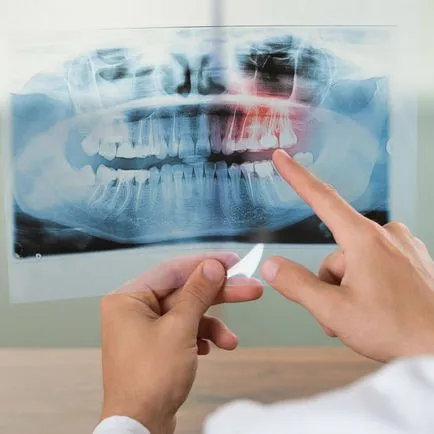 Kapacitás íny periodontitis és implantáció, a leírás és az ár a kezelés