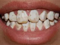 Без кариозни лезии на зъбите - причини, симптоми, диагностика и лечение