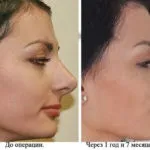 Реабілітація та відновлення після ринопластики (відновлення) Реабілітація та відновлення після ринопластики