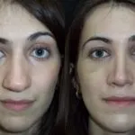 Реабілітація та відновлення після ринопластики (реабілітація) Реабілітація та відновлення після ринопластики
