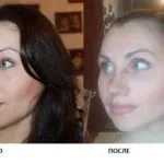 Реабілітація та відновлення після ринопластики (реабілітація) Реабілітація та відновлення після ринопластики