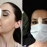 Реабілітація та відновлення після ринопластики (реабілітація) Реабілітація та відновлення після ринопластики