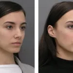 Реабілітація та відновлення після ринопластики (носа після ринопластики) Реабілітація та відновлення після ринопластики