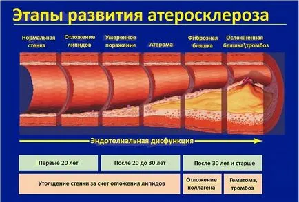 ateroscleroza arterelor Nestenoziruyuschy brachiocefalic extracraniene - tratamentul GCA