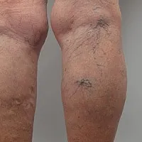 Elzáródásos trombózis suralnyh mediális vénák az alsó végtag mélyvénás alsó lábszár kezelés