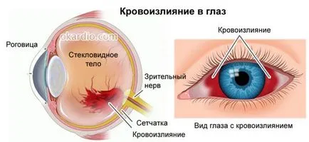 От тогава избухна кръвоносните съдове в очите на причините, поради които едно дете и един възрастен, а често и лечение