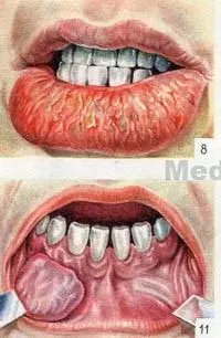 Papilloma vastagbél polip kezelésére népi alapok végbél tünetek, kezelés,