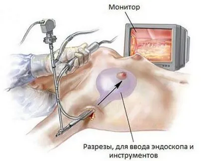 Гръдните импланти гърдата пластмаса, асансьор, увеличение