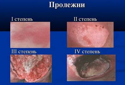 Защо получавам рани по задните части и как се отнасят към моя живот