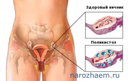 Яке лікування полікістозу яєчників ефективніше, проблеми чоловічого і жіночого безпліддя і методи їх (лікування полікістозу яєчників народні засоби) Яке лікування полікістозу яєчників ефективніше, проблеми чоловічого і жіночого безпліддя і методи їх